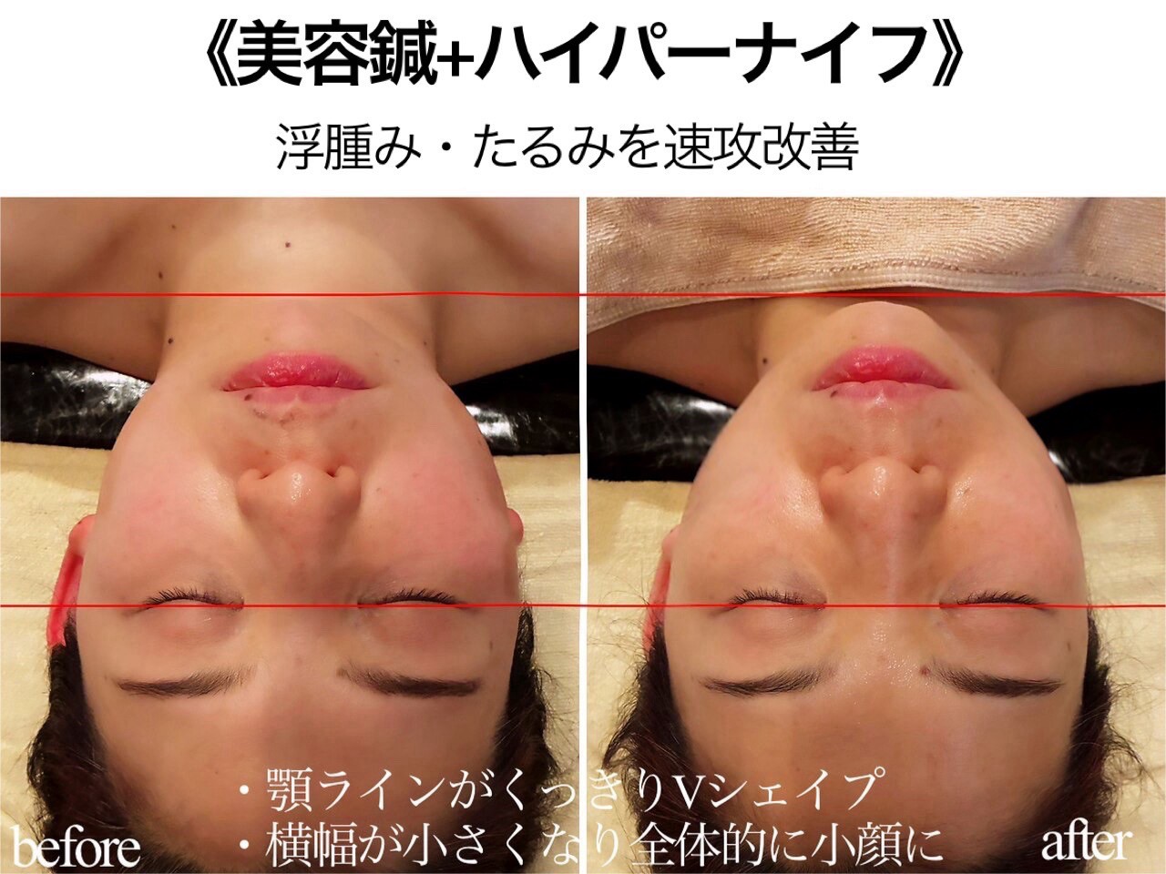 美容鍼+ハイパーナイフ